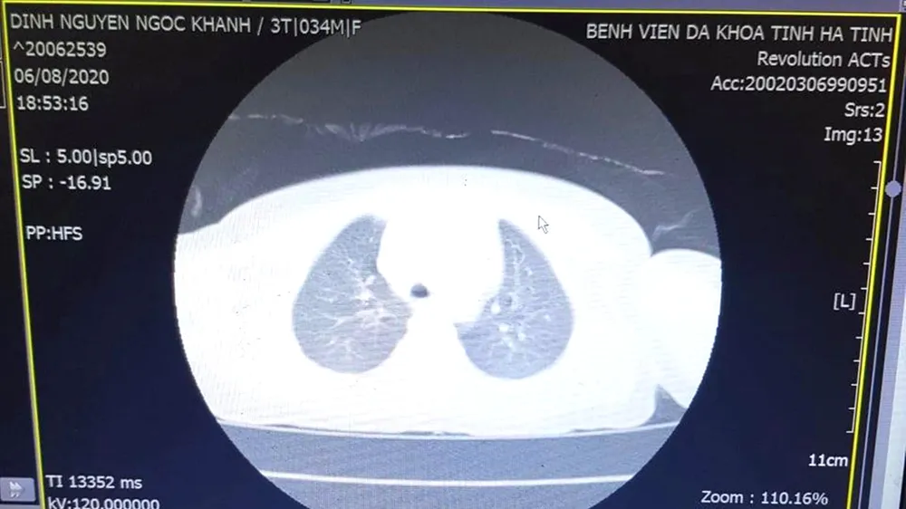 Hình ảnh dị vật thông qua chụp CT- Scanner của bệnh nhi K.