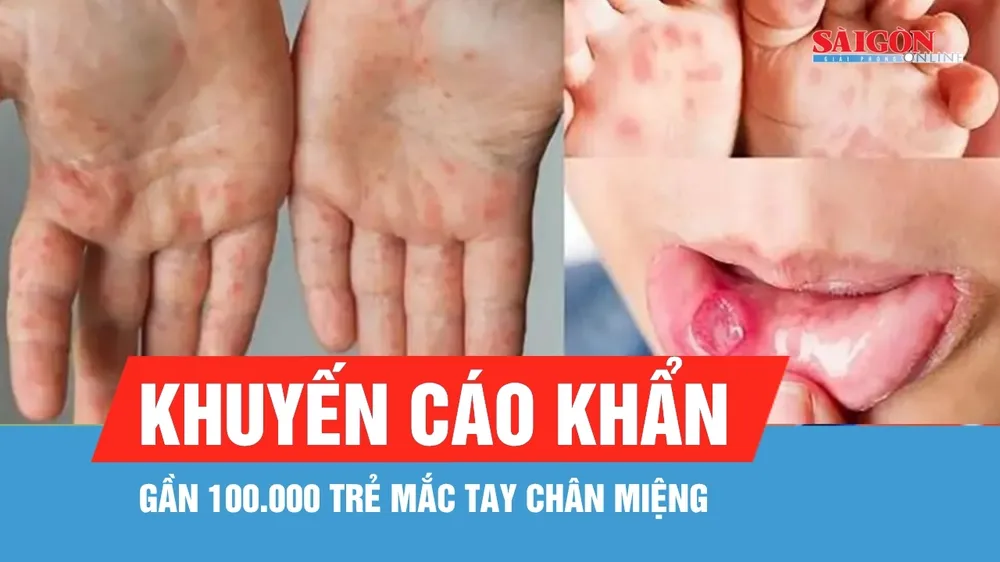 Gần 100.000 trẻ mắc tay chân miệng, Cục Phòng bệnh khuyến cáo khẩn