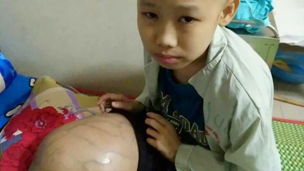 Bé bị ung thư xương, chân sưng to 