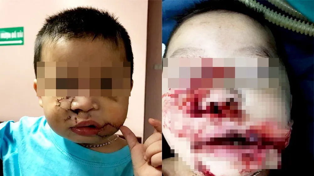 Một cháu bé được phẫu thuật tạo hình vùng mặt sau khi bị chó nuôi cắn gây thương tích nặng