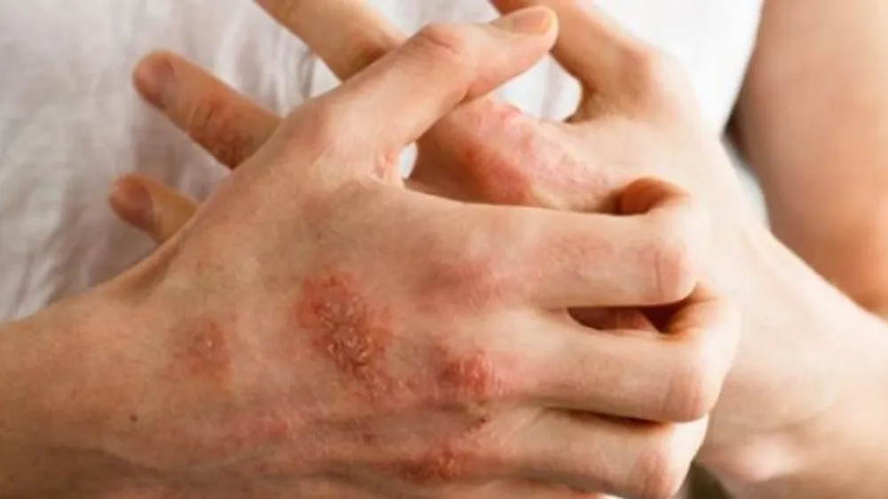 Ngứa rát toàn thân do thoa rượu ngâm gừng, nghệ