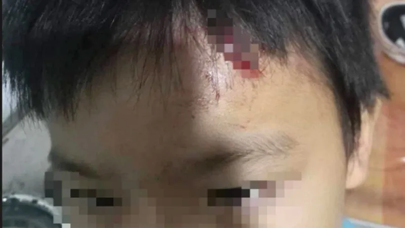 Cà Mau: Nghi mẹ kế tái diễn bạo hành con chồng 