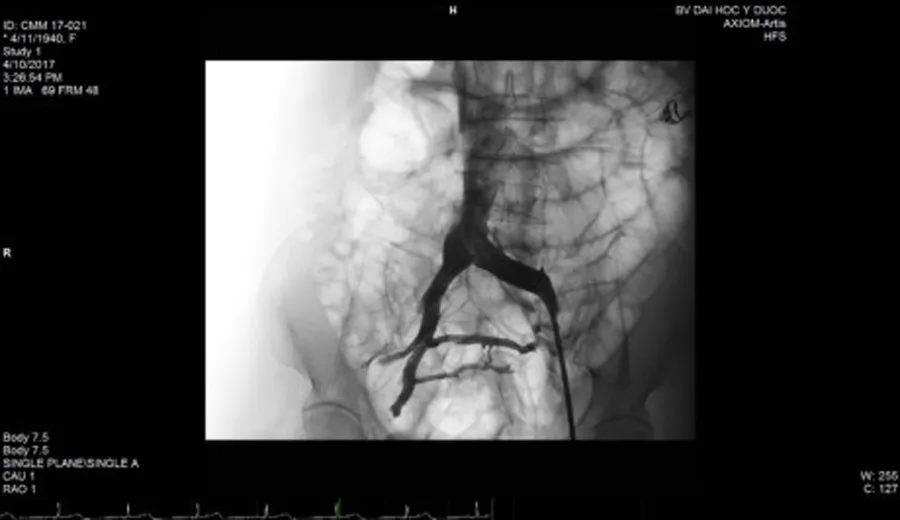 Hình ảnh stent đặt trong lòng tĩnh mạch