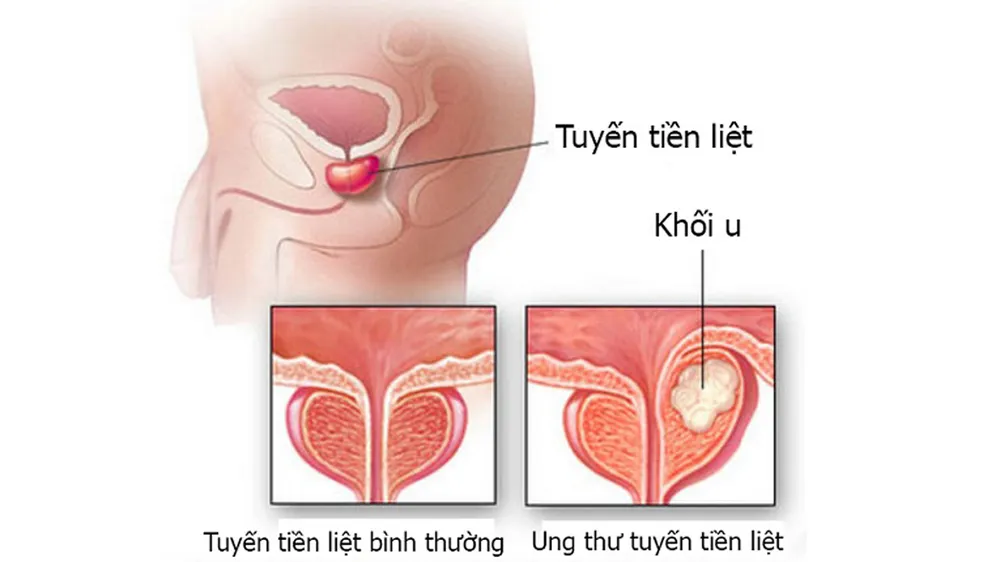 Hơn 1.275 trường hợp mắc mới ung thư tuyến tiền liệt mỗi năm