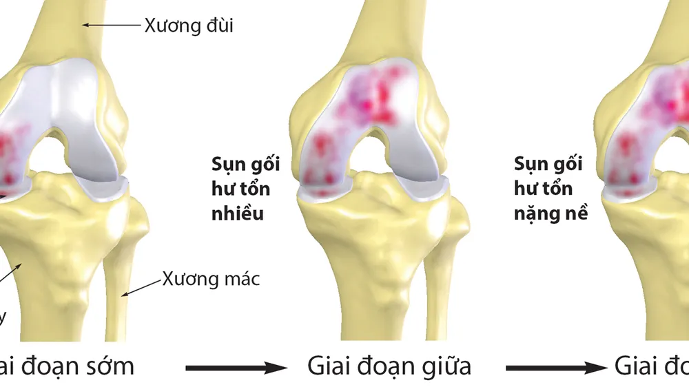 Bệnh nhân thoái hóa xương, khớp ngày càng trẻ hóa