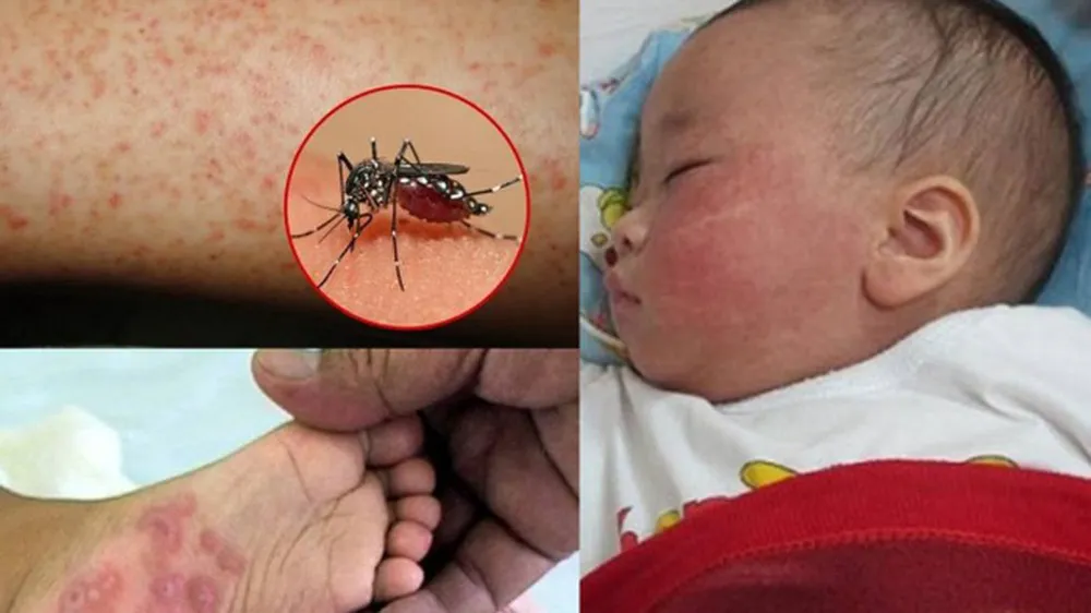 TPHCM: Bệnh sốt xuất huyết, tay chân miệng và sởi giảm