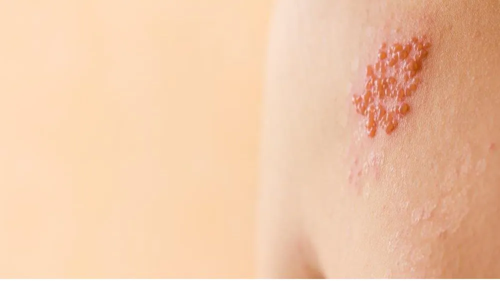 Số người khám các bệnh lý về da gia tăng