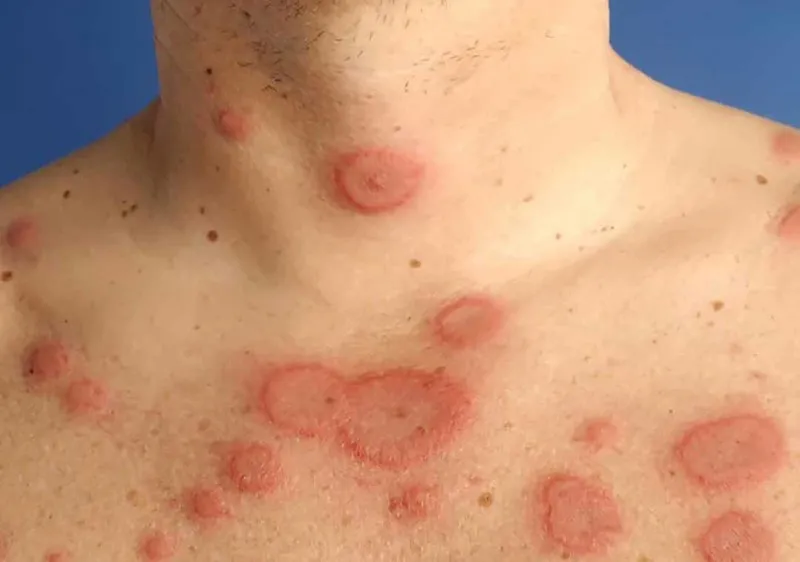 Bệnh nhân được xuất viện sau 7 ngày hậu phẫu