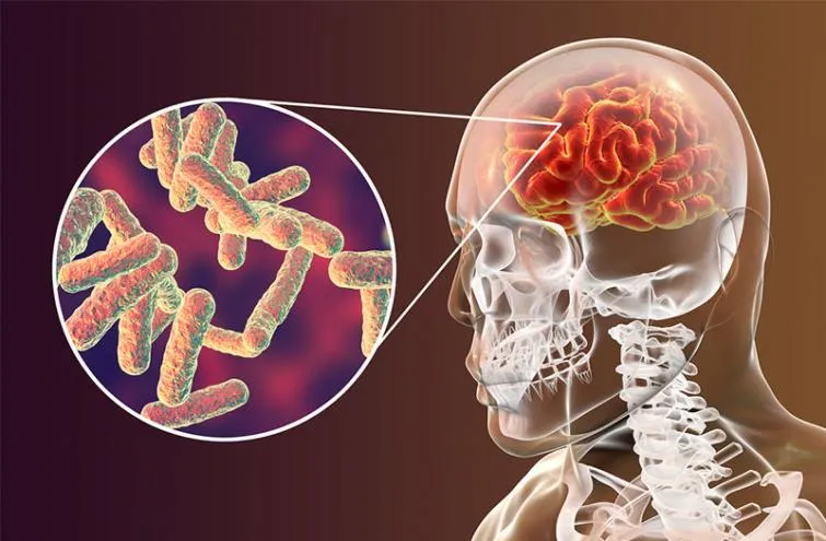 Cứu sống người bệnh bị lao màng não