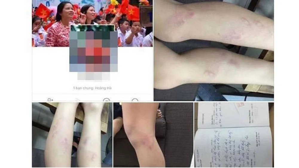 Học sinh M.Đ bị đánh tím chân và sổ khám tại bệnh viện. Ảnh chụp màn hình