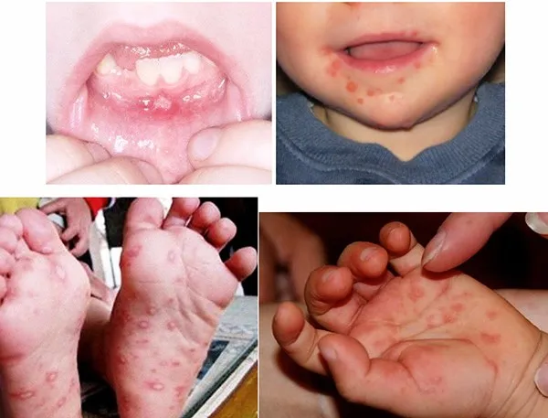 Cẩn trọng với dung dịch trị bệnh tay chân miệng