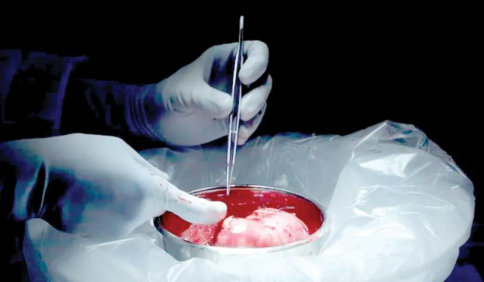 Ghép thận từ người hiến tạng nhiễm HIV còn sống