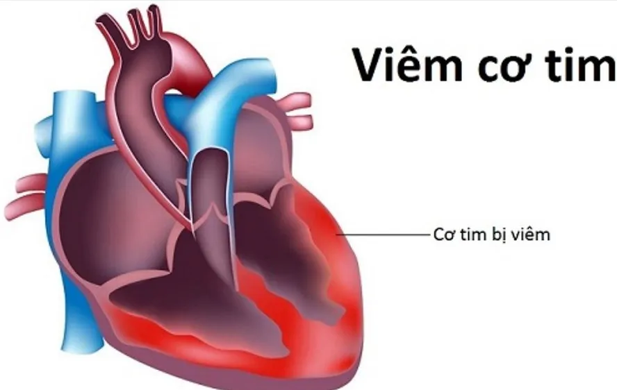 Không tồn tại virus lạ gây viêm cơ tim