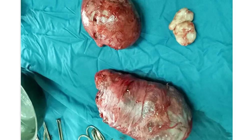 Mổ thành công sản phụ có khối u tử cung nặng hơn 1kg