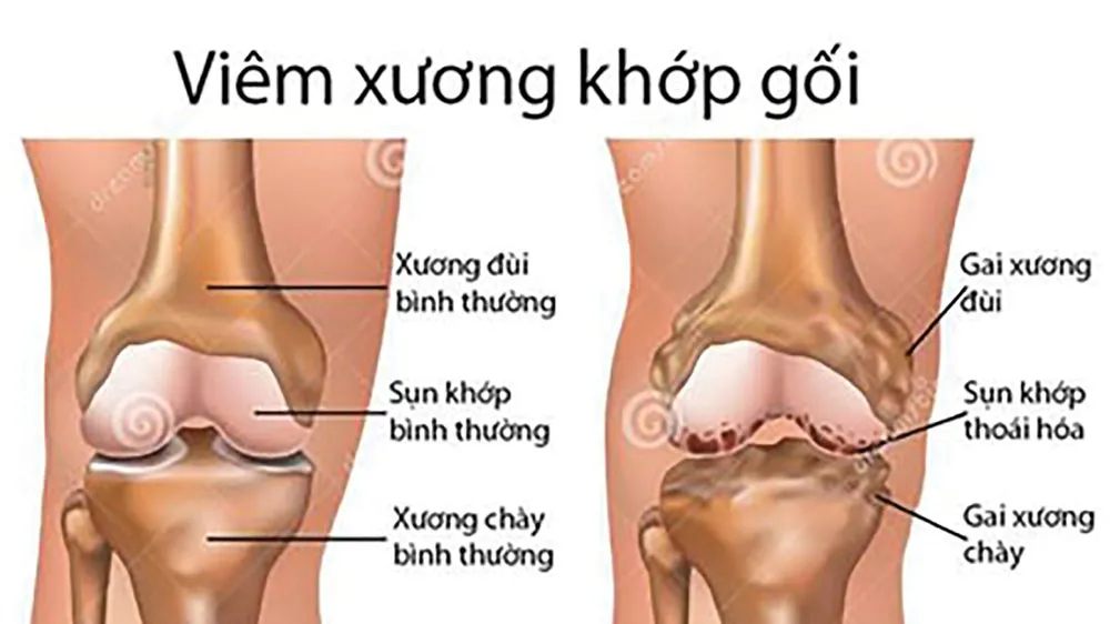 Từ biệt đau đớn do bệnh xương khớp