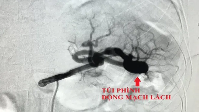 Cứu sống bệnh nhân bị phình động mạch lách