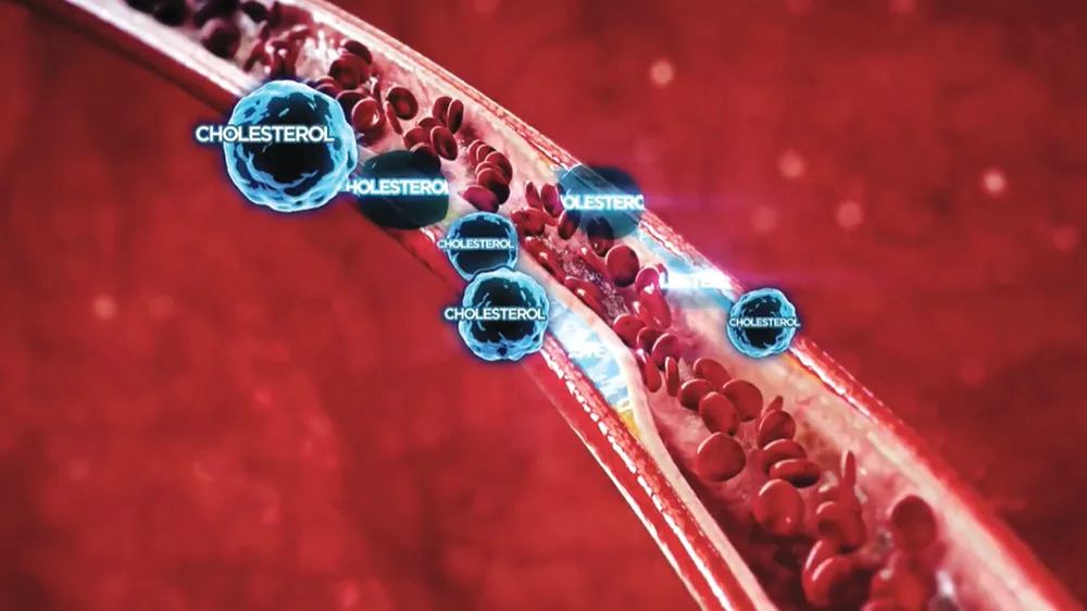 Kiểm soát cholesterol tốt, giảm 27% nguy cơ đột quỵ