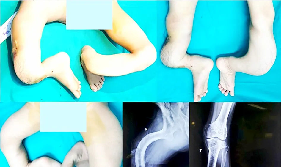 Phẫu thuật thành công cho bệnh nhân có đôi chân như rễ cây