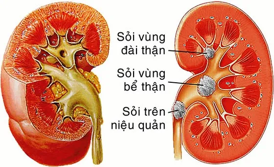 Điều trị sỏi thận không xâm lấn bằng phương pháp tán sỏi ngoài cơ thể