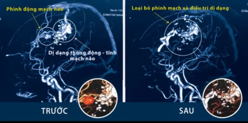 Ảnh chụp CT trước và sau khi phẫu thuật