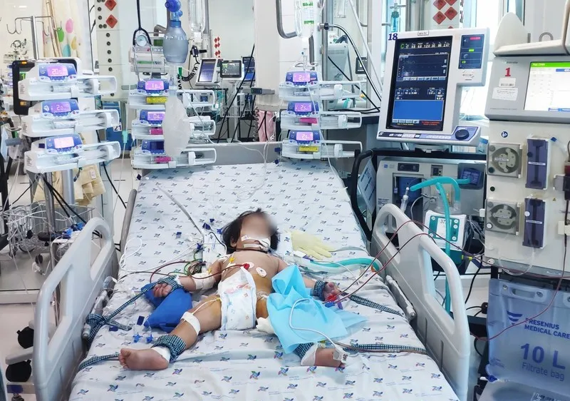 Bé gái trụy tim, nguy kịch do mắc tay chân miệng. Ảnh: Bệnh viện cung cấp
