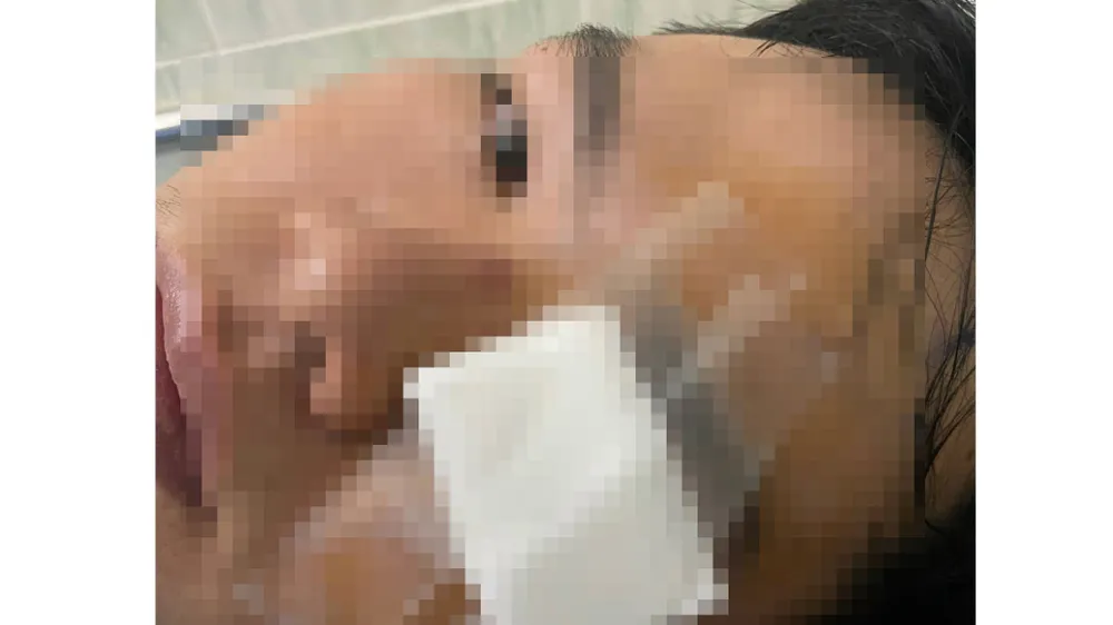 Anh N. với thương tích trên mắt.