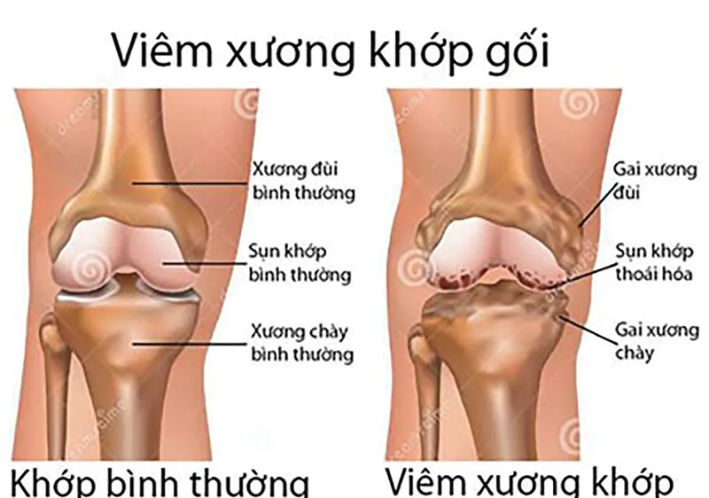Từ biệt đau đớn do bệnh xương khớp