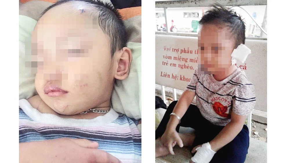 Bé trai 3 tuổi ở Bình Dương nghi bị mẹ ruột và cha dượng bạo hành