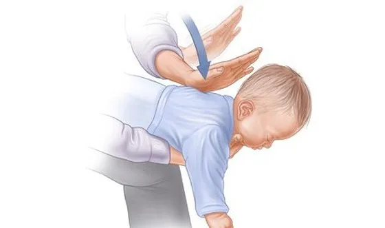 Khi trẻ bị hóc dị vật cần phải được sơ cứu kịp thời và đúng cách. Ảnh minh họa.
