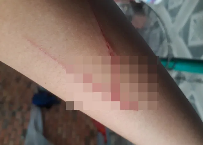 Bé gái thừa nhận vết thương trên tay là do tự dùng vật nhọn rạch vào tay mình, không phải bị người khác gây thương tích như trình báo ban đầu