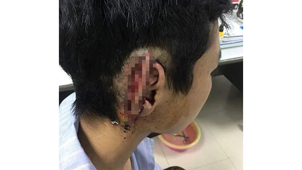 Em T.Đ.T. với vành tai bị cắn đứt