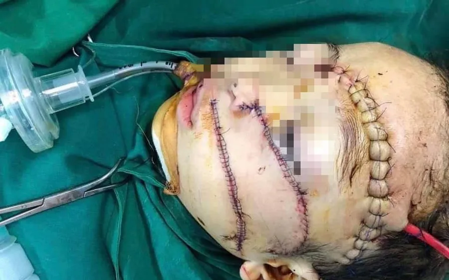 Khâu gần 300 mũi, cứu sống cháu bé bị cha chém nguy kịch