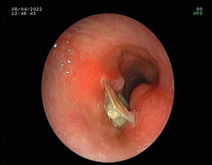 Ho kéo dài do dị vật đường thở