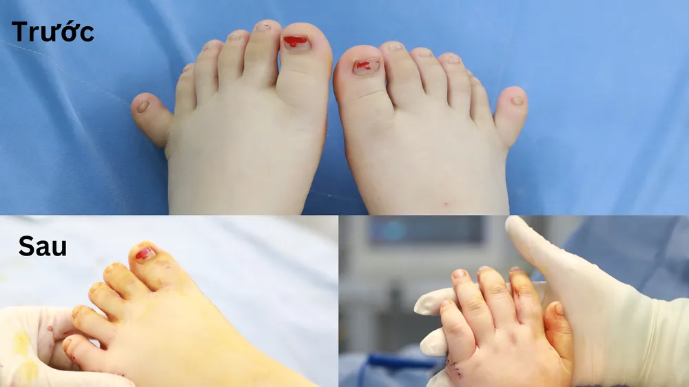 Một số hình ảnh tay chân cháu L. trước và sau khi phẫu thuật