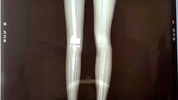 Lần đầu tiên một bệnh nhân đi lại được bằng xương đùi kim loại
