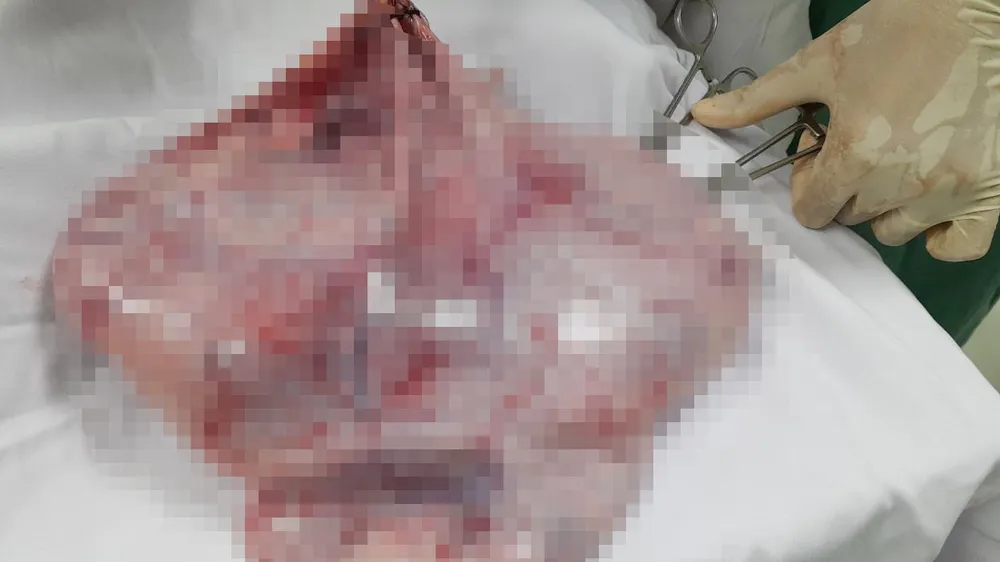 Cô gái 19 tuổi mang khối u buồng trứng 8,5kg