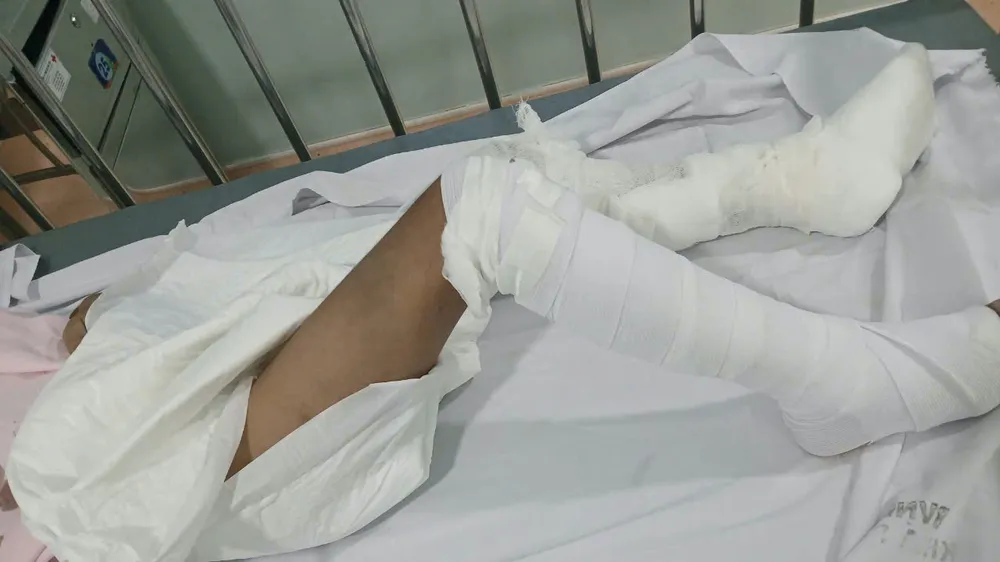 Vết thương trên người bé trai 6 tuổi bị đổ nước sôi được băng bó