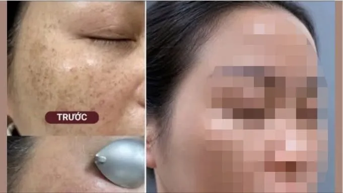 Thực hư chuyện “cải lão hoàn đồng” bằng tia laser