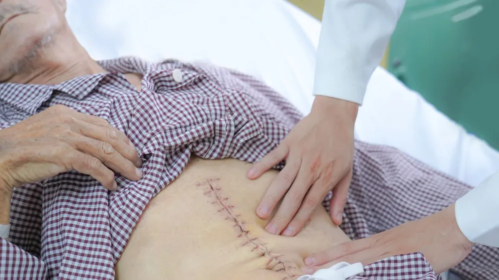Cứu người đàn ông nguy kịch vì phình động mạch chủ bụng