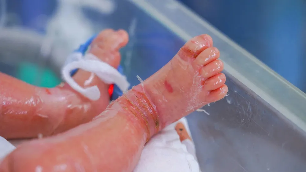 Bé sơ sinh mắc bệnh hiếm gặp, da bong như vảy cá 
