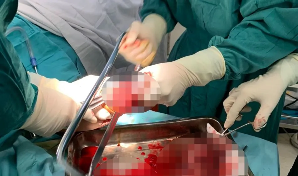 Thanh niên bị nát 2 bàn tay, dập phổi khi dùng kíp nổ để đánh cá