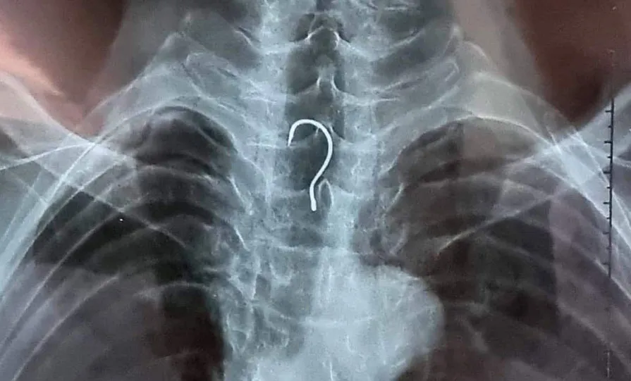 Các bác sĩ tiến hành nội soi gắp lưỡi câu trong thực quản bệnh nhân