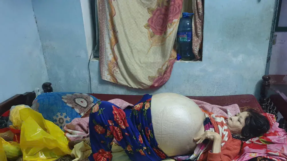 Hỗ trợ người phụ nữ xơ gan giai đoạn cuối