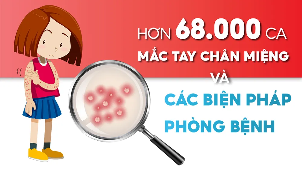 Hơn 68.000 ca mắc tay chân miệng và các pháp phòng bệnh