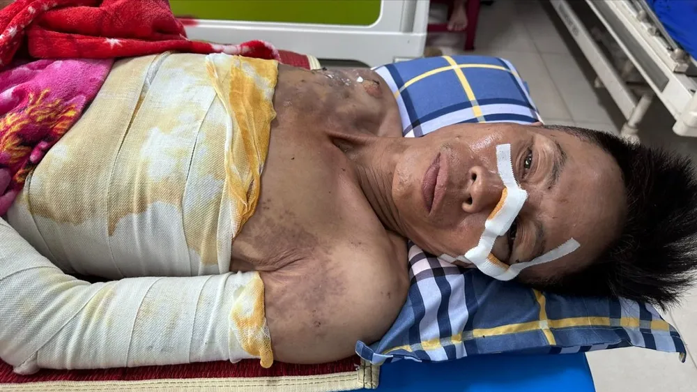Người đàn ông nghèo bị bỏng nặng, không tiền điều trị