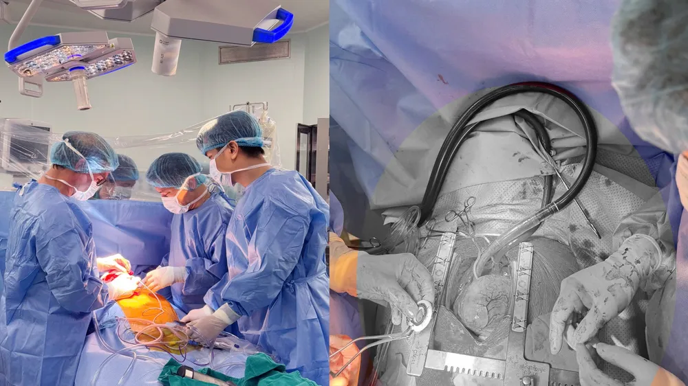 Ca cấy ghép thiết bị hỗ trợ tim CorHeart 6 đầu tiên tại Việt Nam