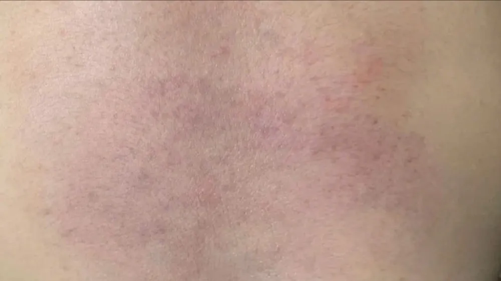 Vết bầm tím trên cơ thể cháu Q. được chia sẻ trên mạng xã hội