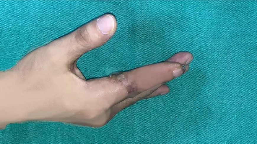 Lần đầu tiên, vi phẫu thành công cứu sống ngón tay của một thủy thủ bị đứt rời sau 25 giờ
