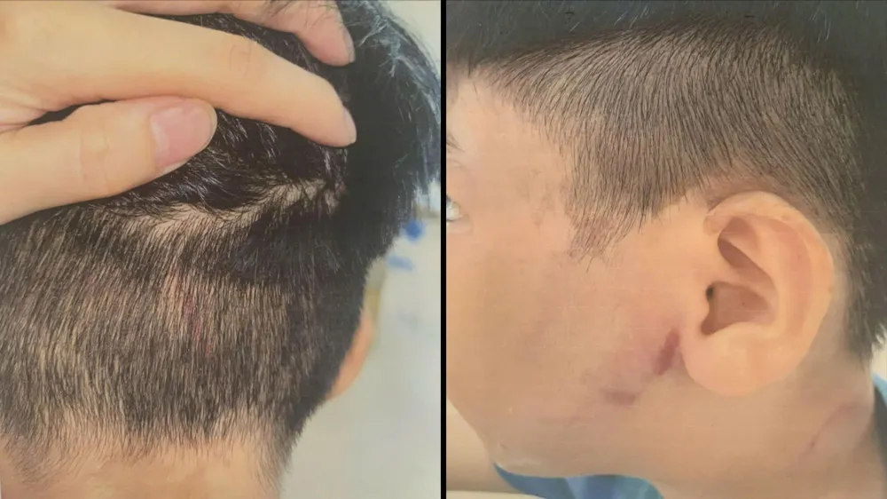 Triệu tập người cha nghi đánh con ruột nhập viện
