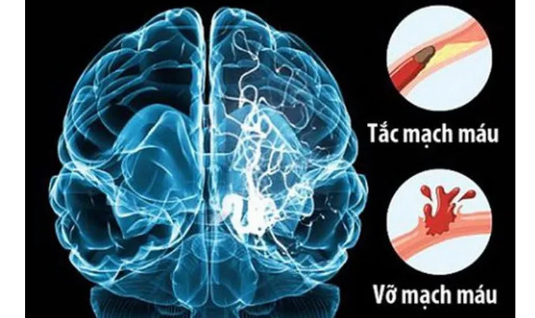 ĐBSCL: Mỗi năm có hơn 10.000 trường hợp đột quỵ